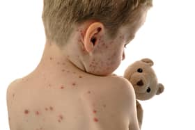 Measles causes a red blotchy rash to spread across the body (Photo: Adobe)