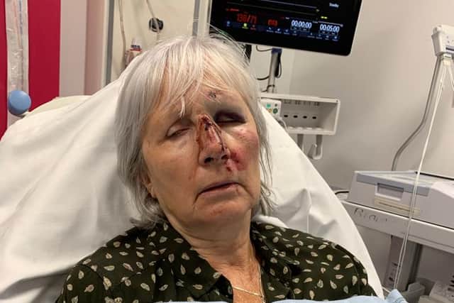 Glenn Lilley after she fell face first into the door as she collapsed before the tumour was discovered.