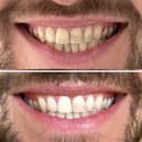 MySweetSmile claims to help put the white back in anyone's smile