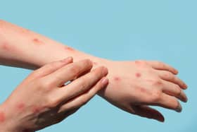 A fifth UK case of mpox Clade Ib has been found in Leeds