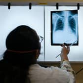 Tuberculosis (TB) cases in England have increased by 13%.