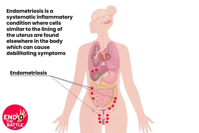 What is endometriosis?