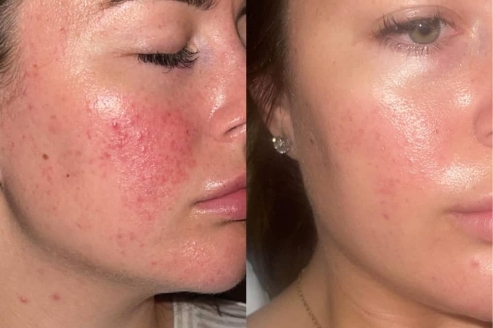 These are before and after images of Jamie, another 47 Skin user