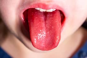 Tongue of a child with scarlet fever - strawberry tongue.