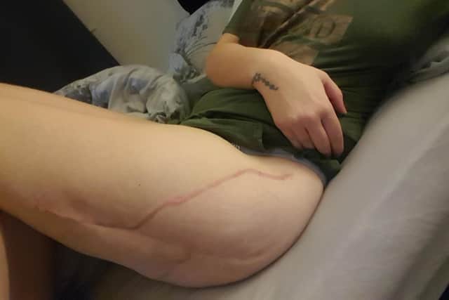 Scarring Kayley Hicken was left with after being hit by a car