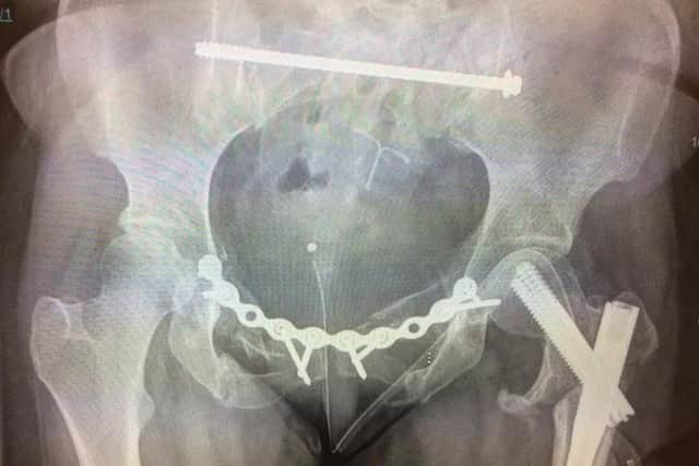 An X-ray showing a steel bolt inserted to treat some of Kayley Hicken's serious injuries