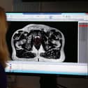 The scan of a patient diagnosed with prostate cancer