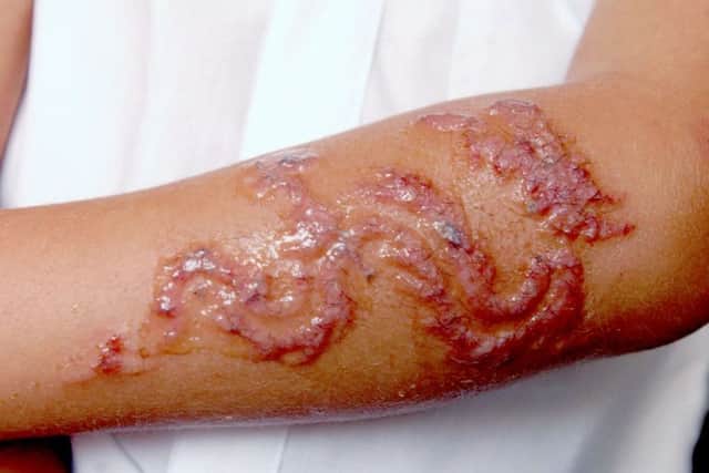 James Wilson (6) whose arms have blistered badley after having Henna tattoos done whilst on holiday NW*23291